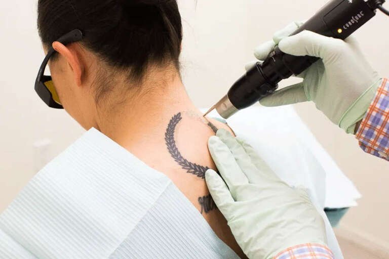 tatoo removal